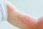 dermatological symptoms, covid-19, dermatological symptoms could be a sign for covid 19 infection, Medical professionals