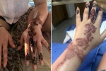 henna burns treatment, henna tattoo, henna tattoo cause aussie woman to almost lose her hand, Tattoos