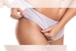 red stretch marks, white stretch marks weight loss, difference between red and white stretch marks explained and it s natural to have them, Stretch marks