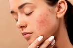 skin, skin, 10 ways to get rid of pimples at home, Skincare