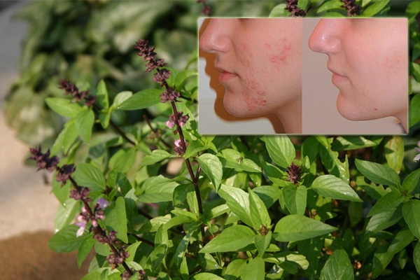Say Good Bye to Pimples with Basil Cream},{Say Good Bye to Pimples with Basil Cream