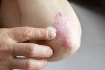 Skin disorders articles, Skin disorders tips, five common skin disorders and their symptoms, Skin disorders
